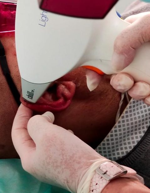 epilazione laser orecchie